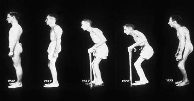 Diagnosis dan Pengobatan Ankylosing Spondylitis